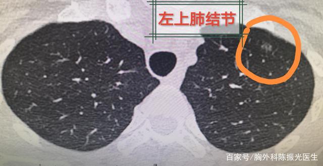 体检发现有肺结节怎么办？ 专家：千万不要恐慌，一定要来找医生