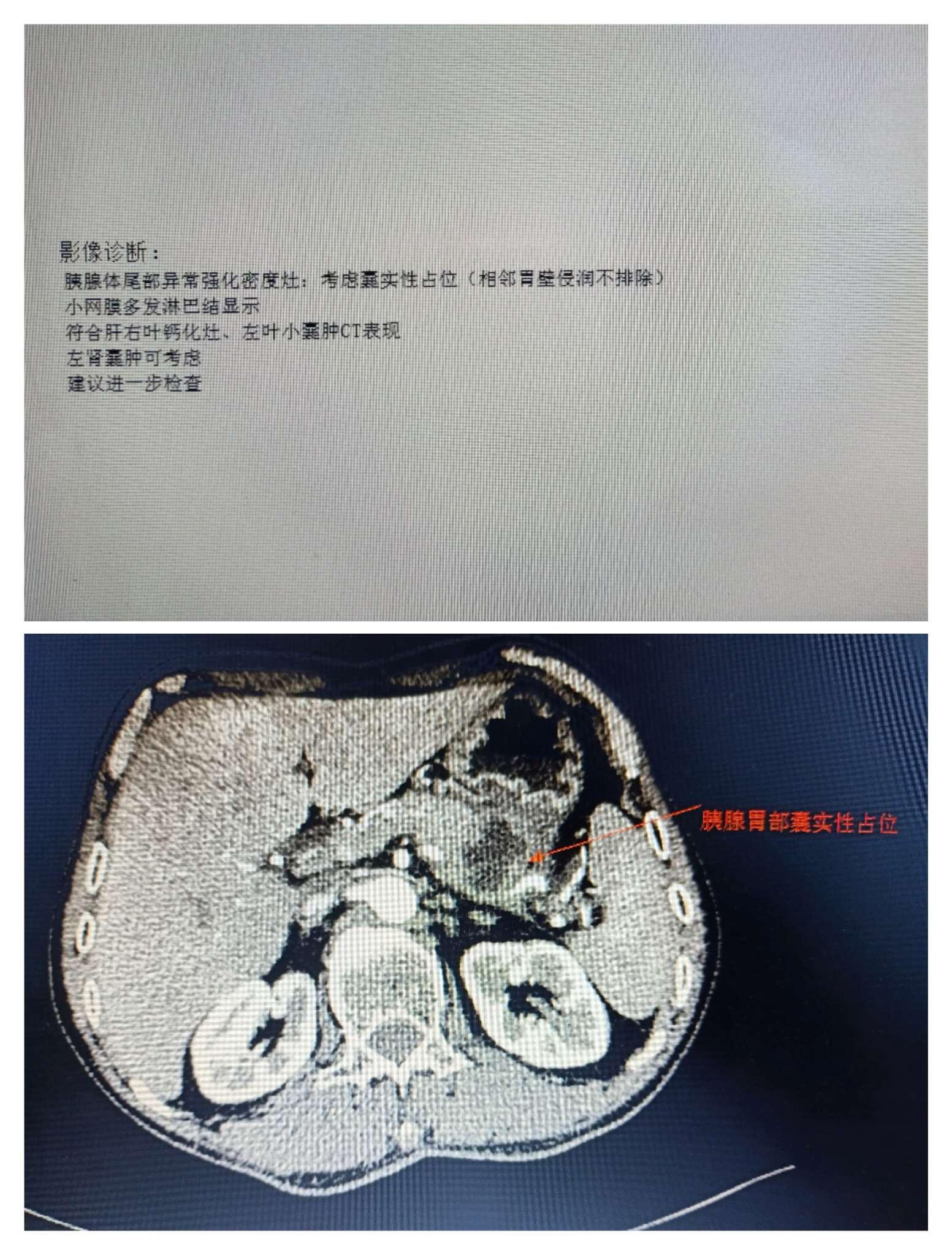 亚虹医药：APL-1202口服联合替雷利珠单抗新辅助治疗肌层浸润性膀胱癌试验在2025年美国临床肿瘤学会泌尿生殖系统肿瘤研讨会上发布Ⅱ期临床试验数据