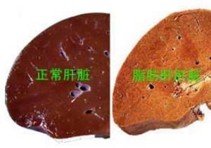 微芯生物：西格列他钠治疗组肝脂肪含量下降明显