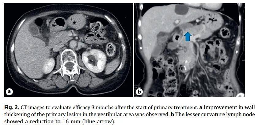 荣昌生物最新公告：维迪西妥单抗一线治疗HER2表达的尿路上皮癌Ⅲ期临床研究达到主要研究终点