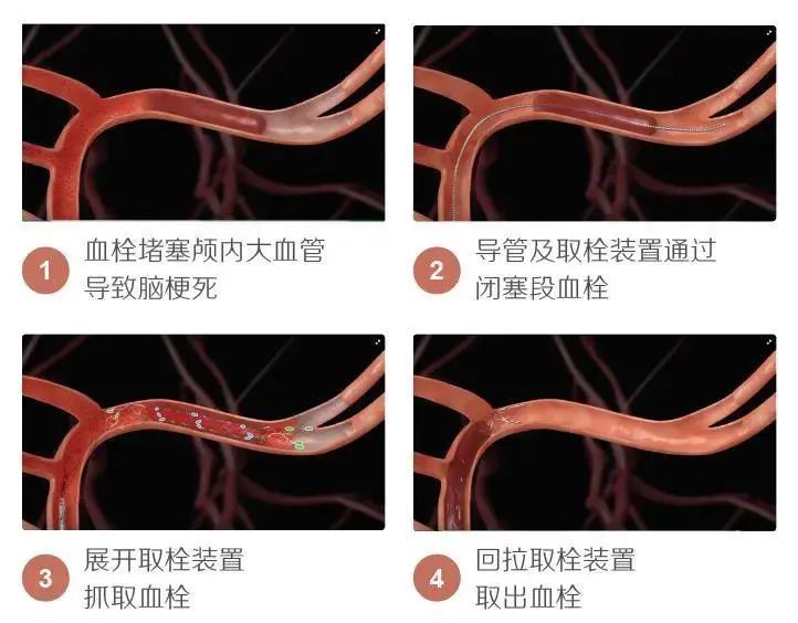 赛诺医疗最新公告：子公司产品Ghunter颅内取栓支架获得欧盟CEMDR认证
